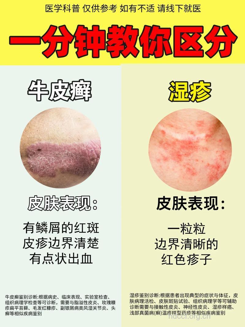皮炎和皮肤癣不是一回事！