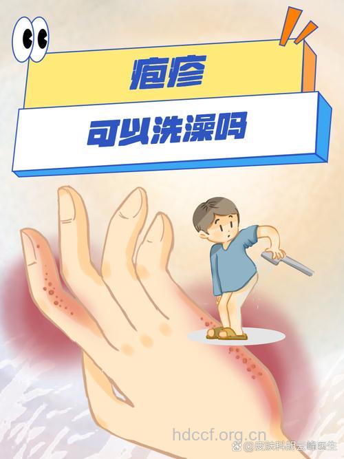 带状疱疹能洗澡吗 你了解吗