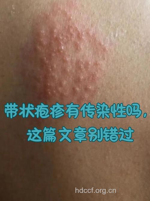 带状疱疹会传染吗？