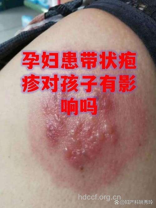 孕早期患上带状疱疹需谨慎