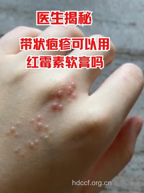 皮肤麻痹小心是带状孢疹