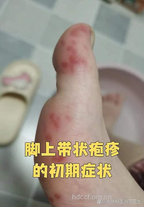 带状疱疹会引起脚疼吗