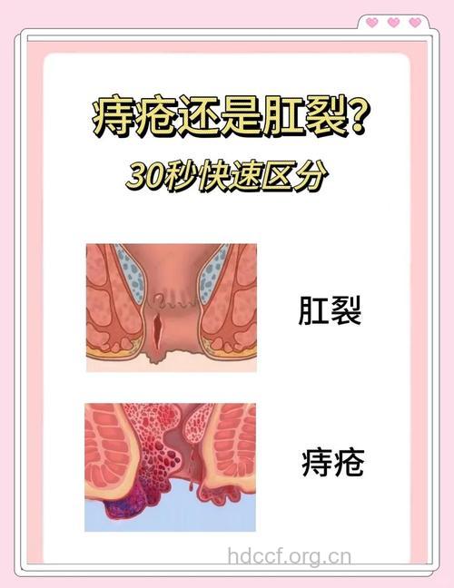 怎么区分痔疮和肛裂