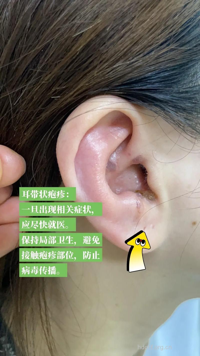 患带状孢疹或引发内耳功能障碍