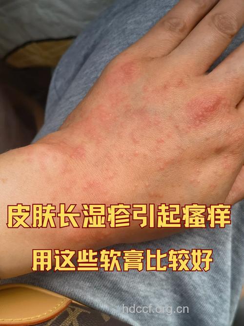 湿疹膏搽水痘红疹可致命