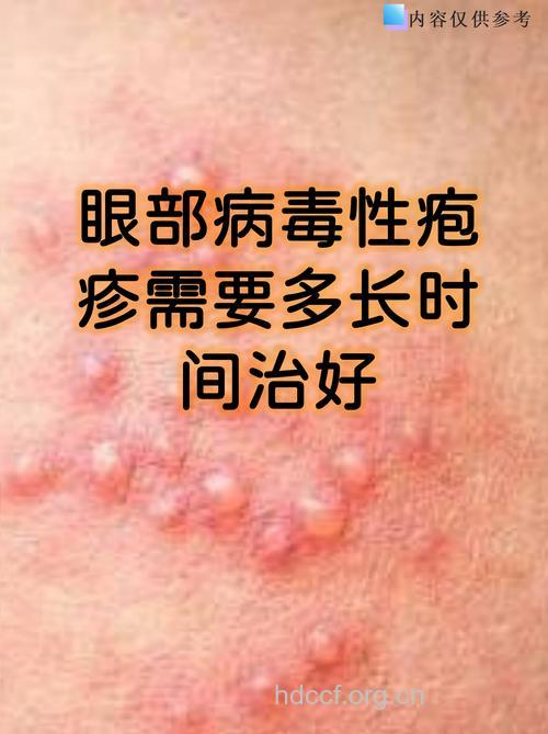 眼部带状疱的发病病毒是什么