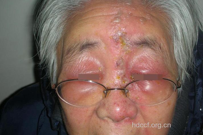 眼部带状疱疹的临床有什么特点