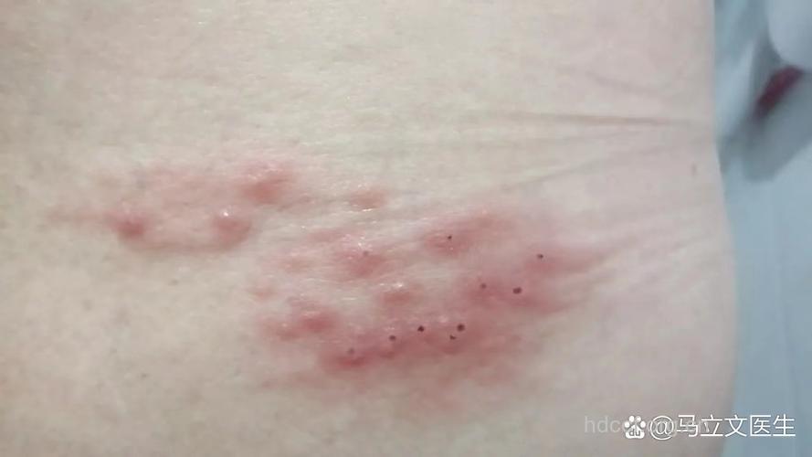 腰背疼小心“带状疱疹”