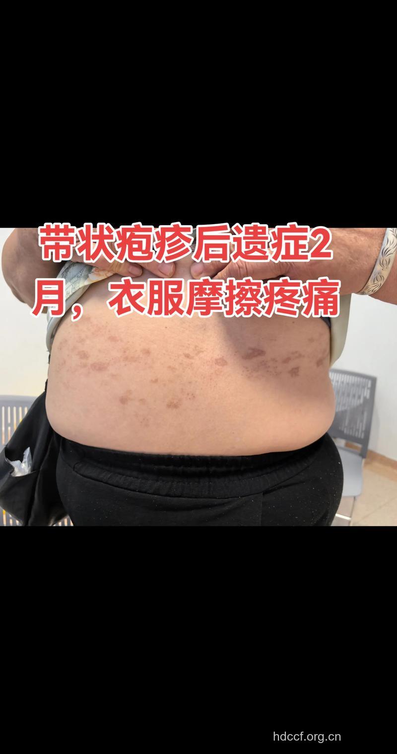 带状疱疹 哪些会有后遗症