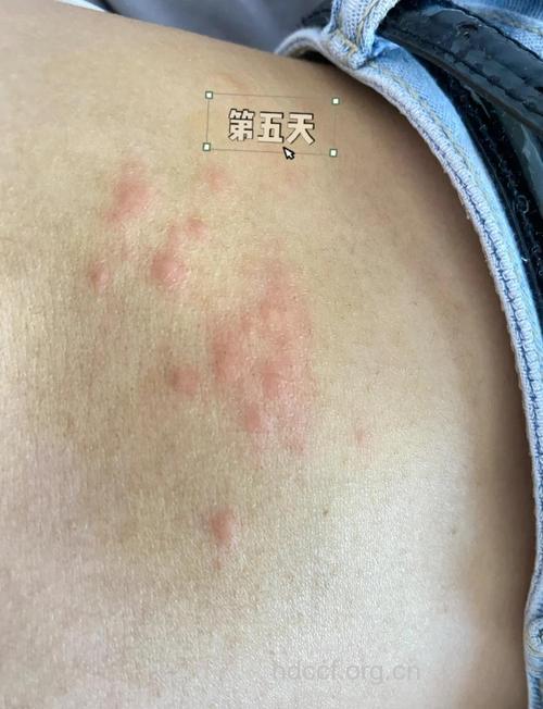 精神压力大易缠上带状疱疹