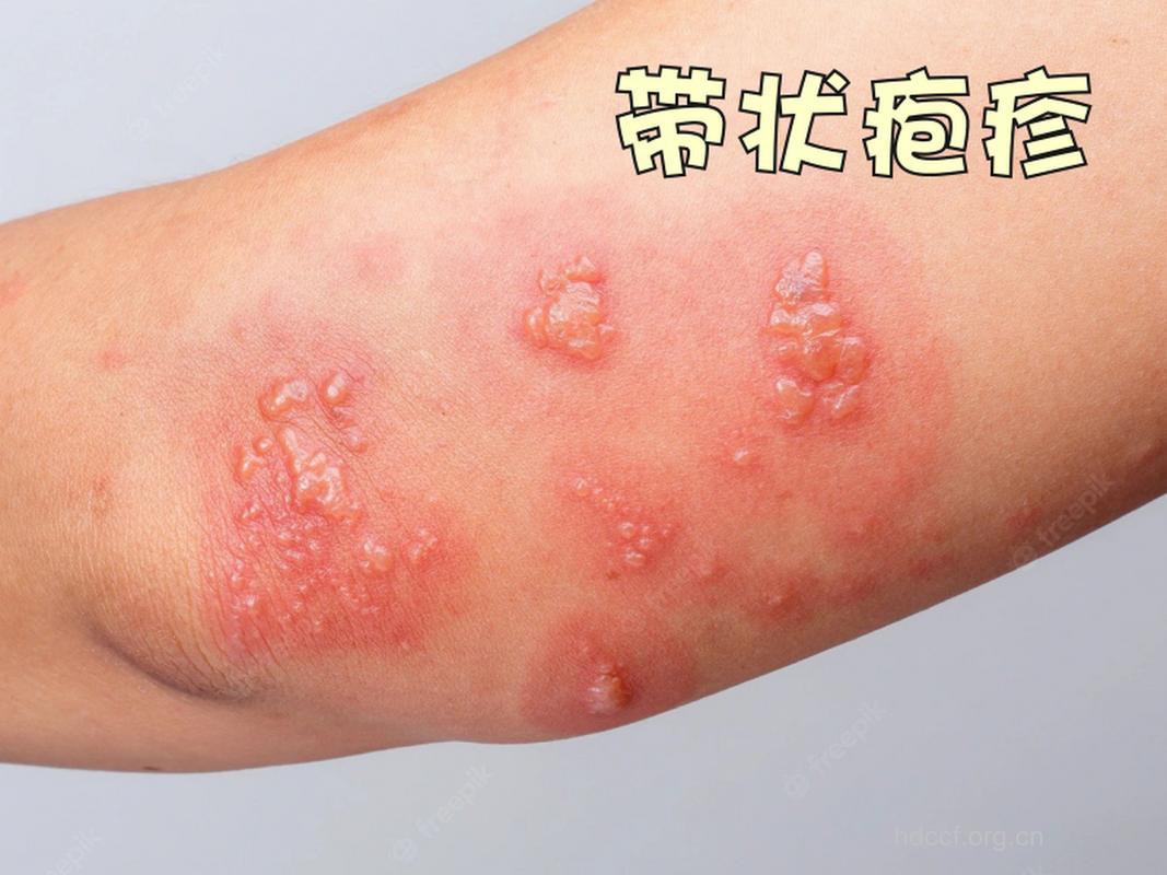 熬夜、劳累引发带状疱疹