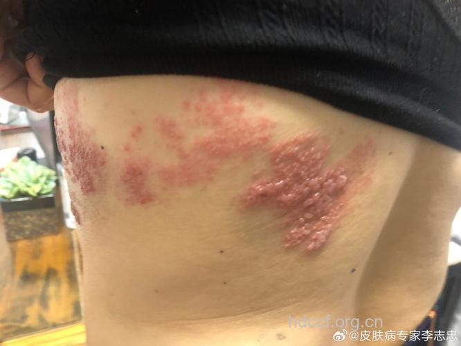 食物可镇带状疱疹后遗神经痛