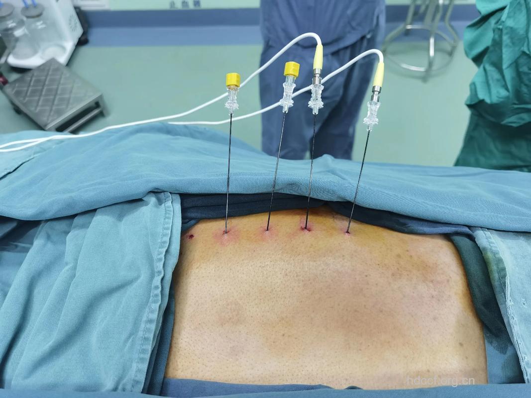 微创治疗带状疱疹后遗神经痛