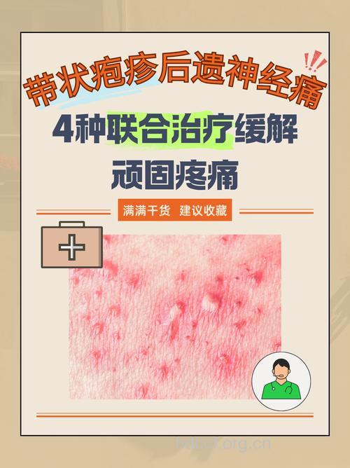 缓解带状疱疹后神经痛
