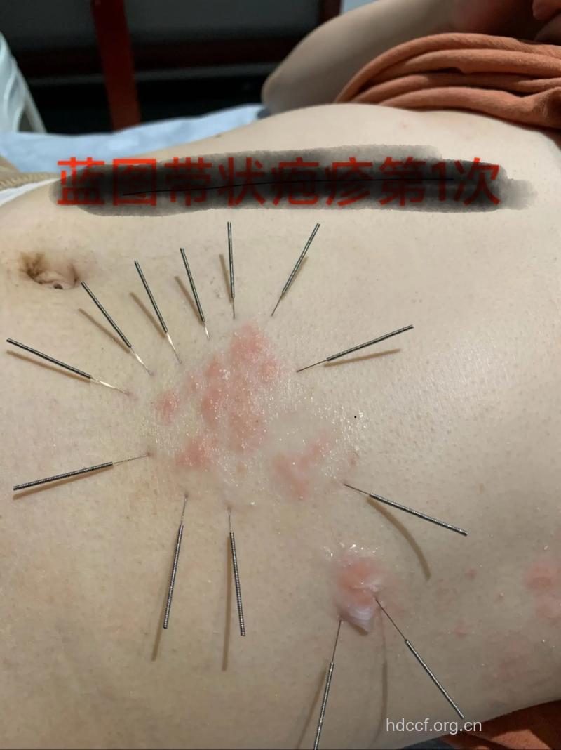 针灸可以治疗带状疱疹