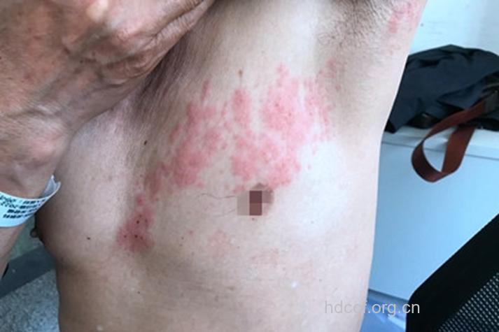 胸痛原是带状疱疹搞怪