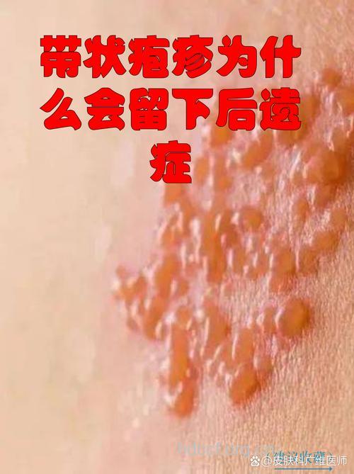 小心!带状疱疹后遗症