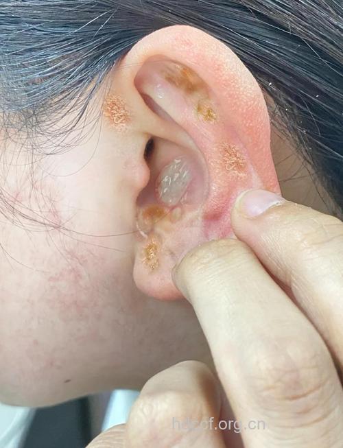 耳带状疱疹有哪些?