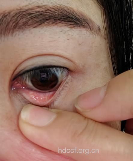 自测眼睑带状疱疹