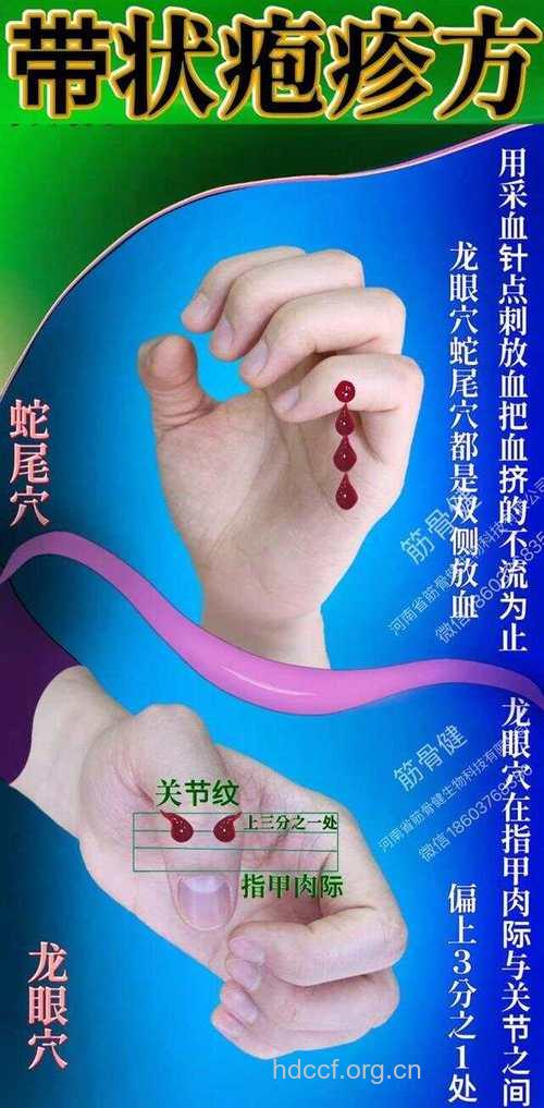 特效方治带状疱疹显身手