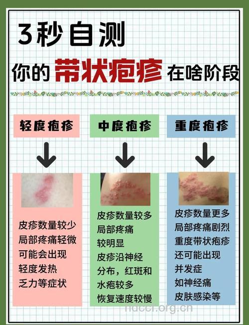 七条小妙方教你治带状疱疹