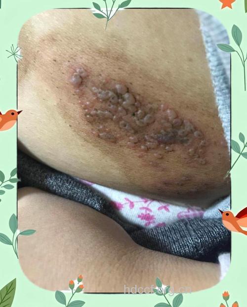 带状疱疹后遗神经痛的表现