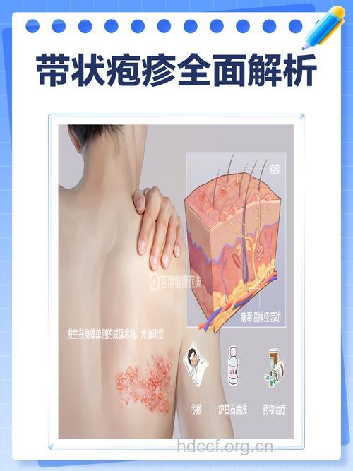 带状疱疹知多少