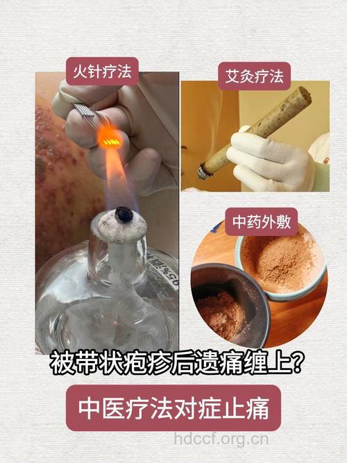 中医治疗带状疱疹
