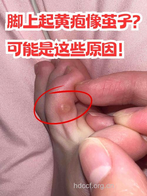 脚疼可能是带状疱疹捣乱