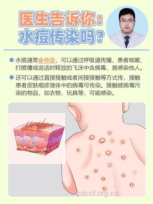 哪些人群最容易受到水痘带状疱疹病毒的侵害