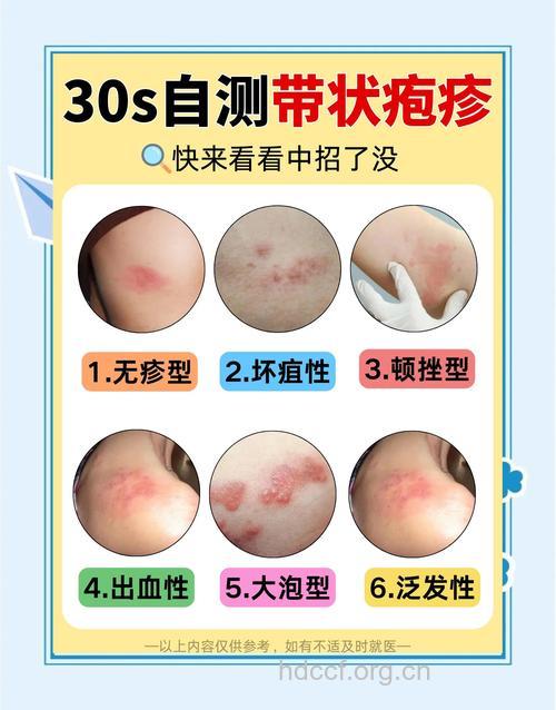 带状疱疹症状和类型