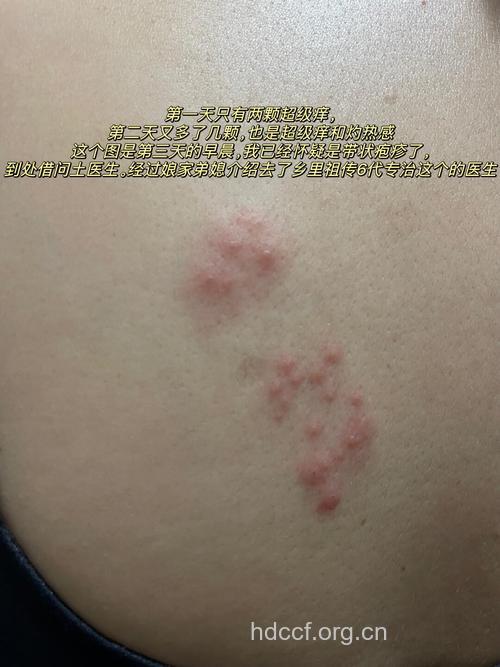 带状孢疹有哪些临床表现