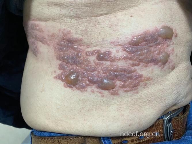 带状孢疹有哪些症状表现