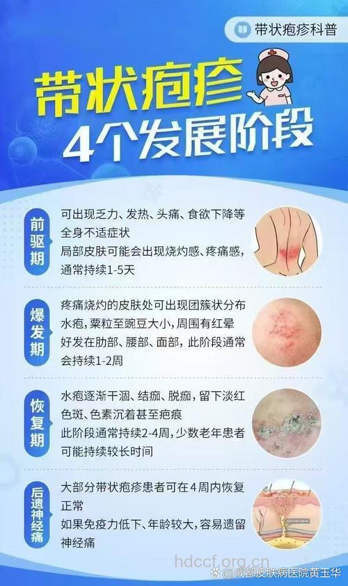春季为什么易得带状孢疹