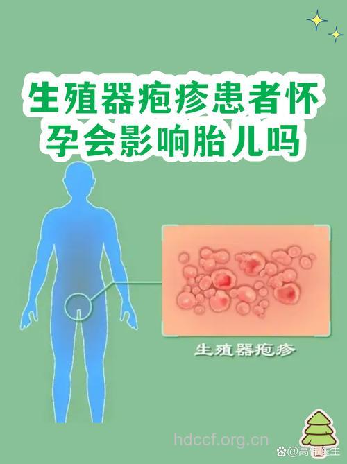 疱疹患者能怀孕生子吗？