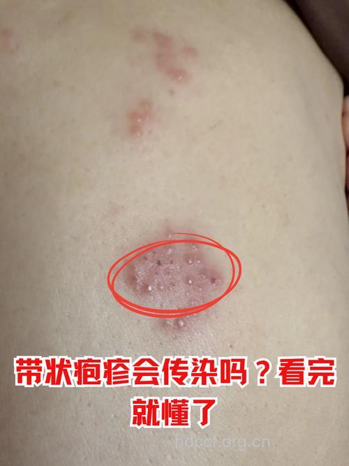 带状疱疹是水痘引起皮肤病？