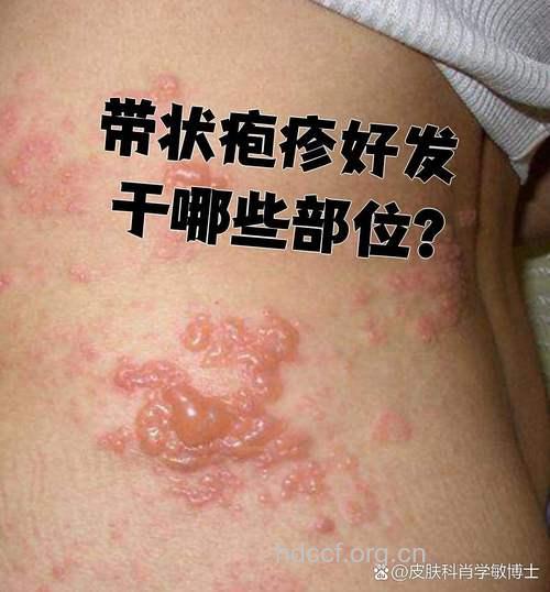 带状疱疹通常出现在哪些部位