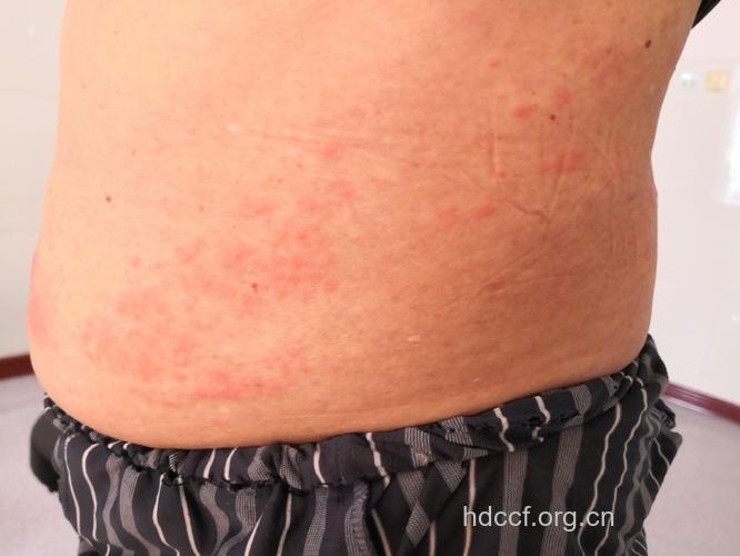 腰部出现丘疹或患带状疱疹
