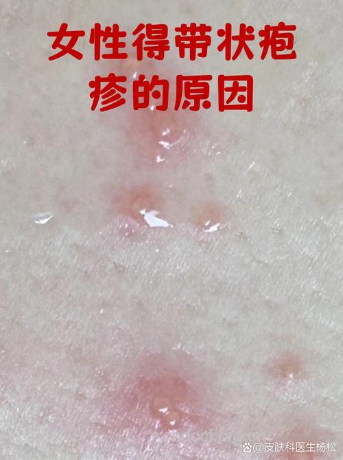 免疫力下降易感染带状疱疹