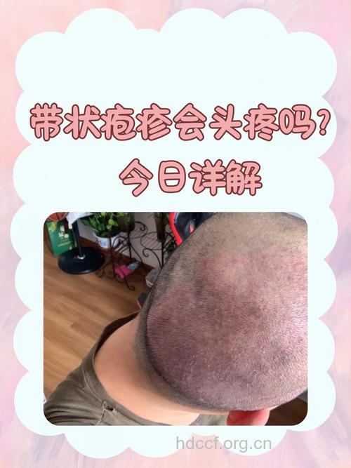 头痛可能是带状疱疹的信号