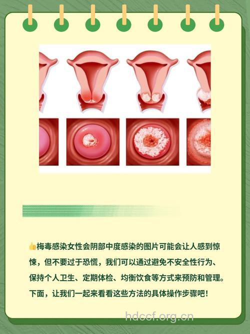 怎样面对得了性病的女人