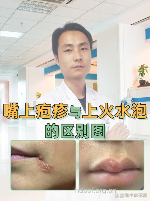 辨别疱疹和上火