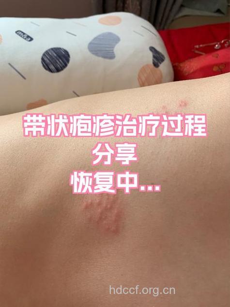 九天治愈急性期带状疱疹