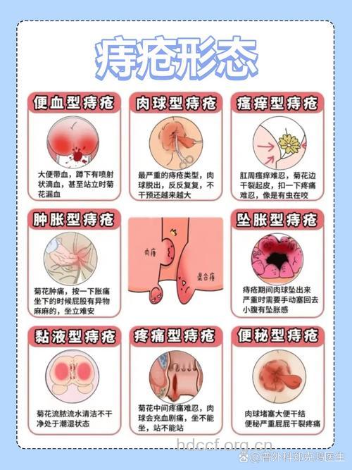 老人痔疮有哪些发病特点