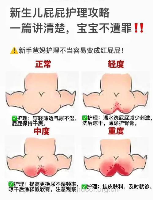 宝宝肛裂有哪些呵护方法