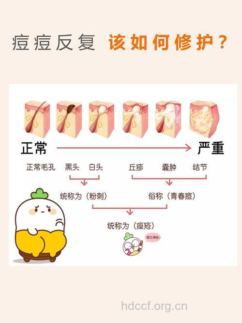 警惕 痤疮形成的七个原因