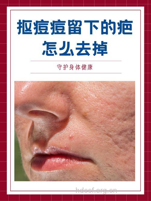 巧妙利用这东西可以祛除痤疮疤痕哦