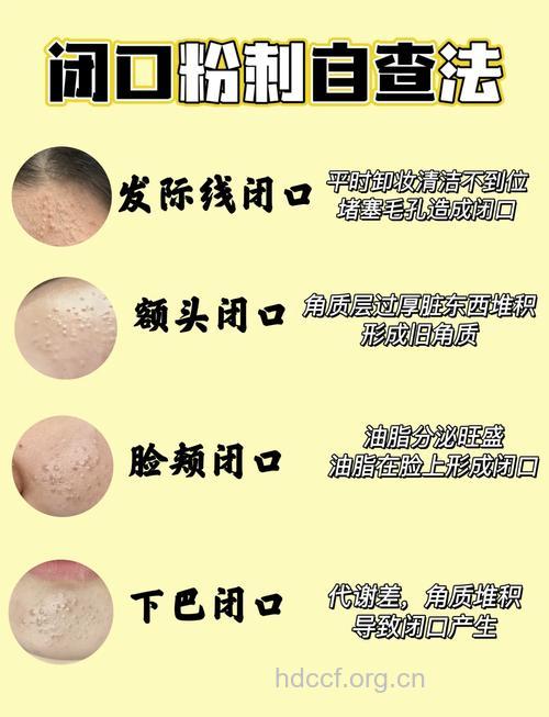 长粉刺不用怕 三招教你对付粉刺