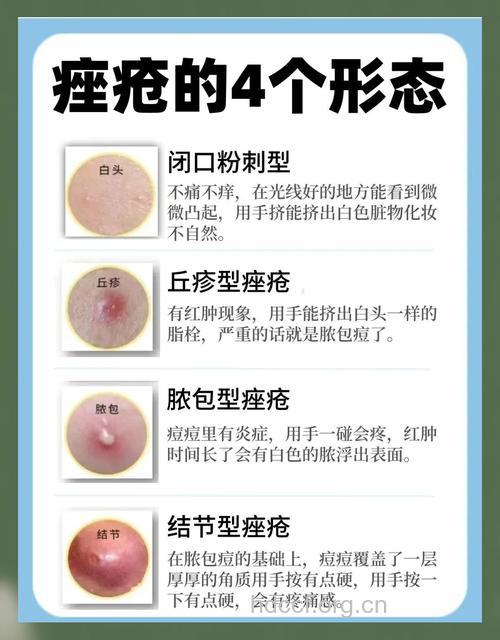 便秘引起痤疮 患者该怎么治疗