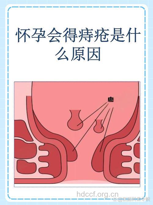 女性怀孕为什么会导致痔疮